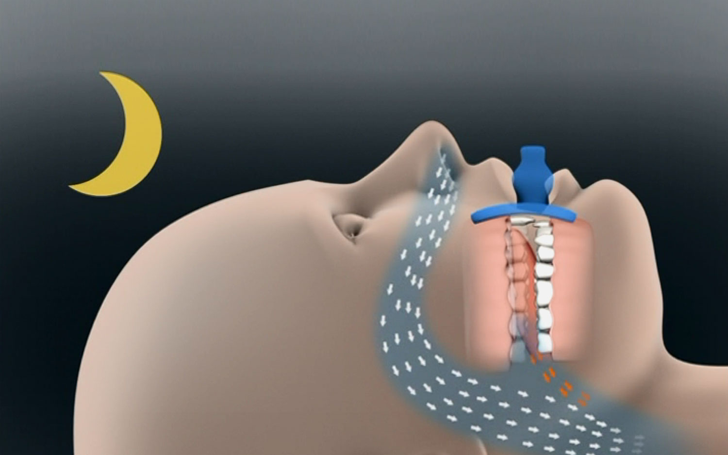 Treating snoring and sleep apnea – What you should know about