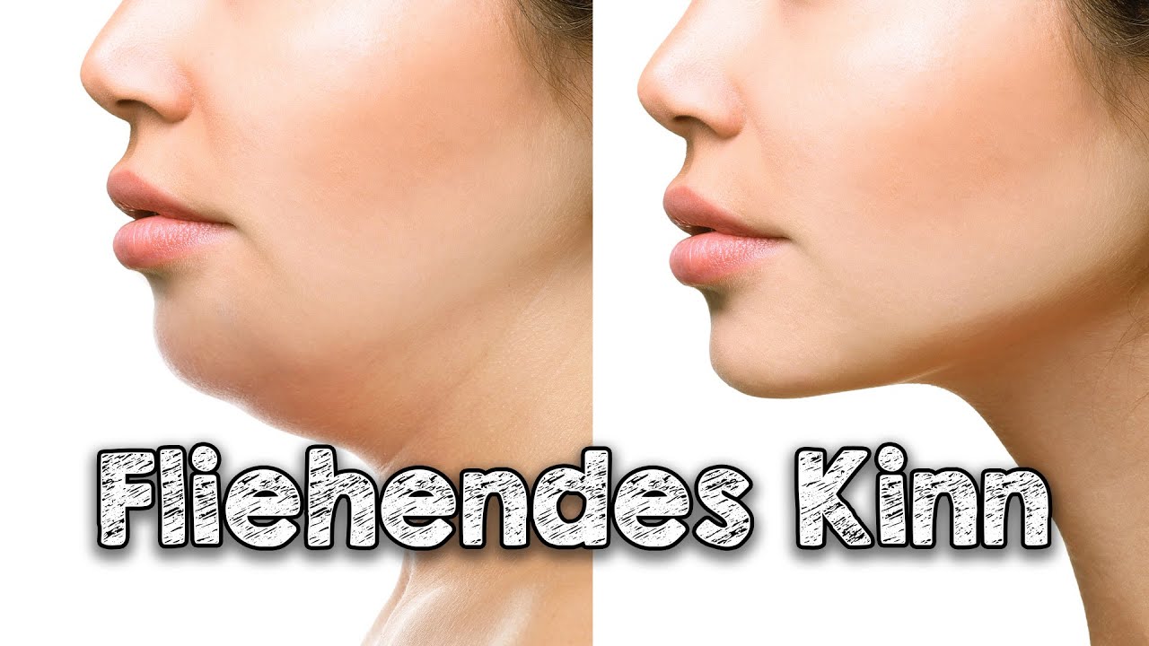 Doppelkinn –  Fliehendes Kinn