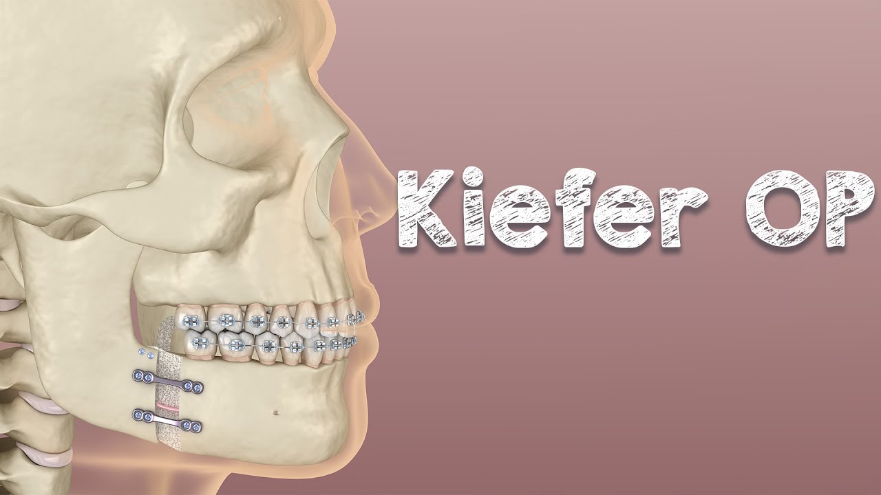 Kiefer Operation – BiMax – Risiko ohne Erfolgsgarantie und bleibenden Ursachen