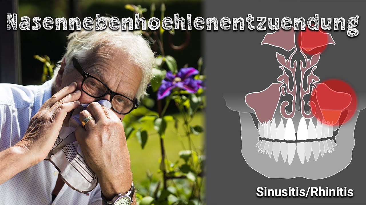 Nasennebenhöhlen – Chronische Entzündungen – Korrekte Belüftung und Vermeidung von OP