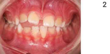 Figure 2: Treatment course of open bite, initial situation