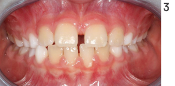 Figure 3: Course of treatment for open bite, interim status