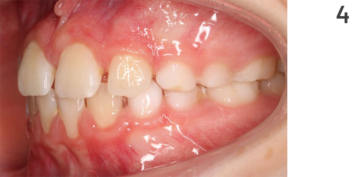 Figure 4: Course of treatment for open bite, interim status